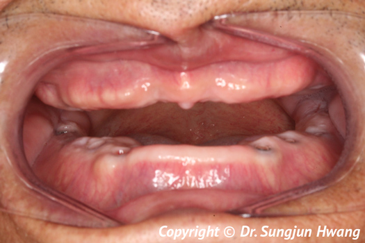 Before-dental implants