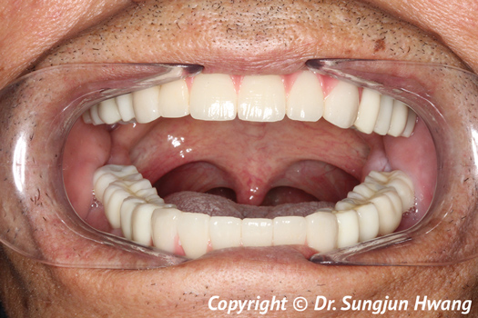 After-dental implants