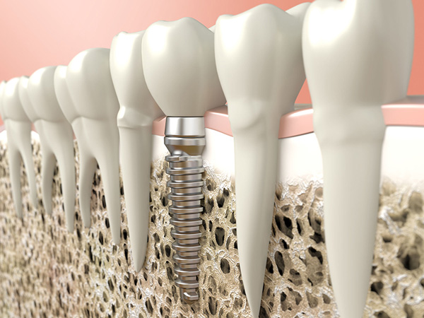 dental implant illustration